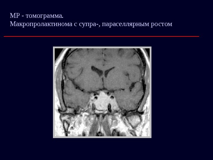 МР - томограмма.     Макропролактинома с супра-, параселлярным ростом 