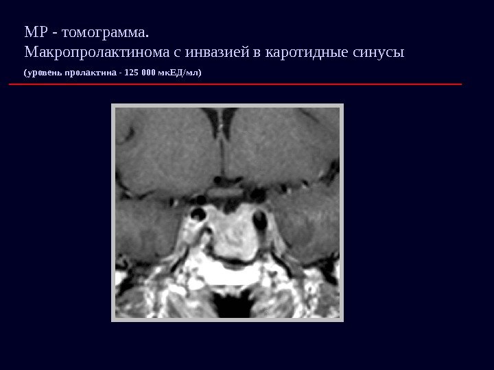 МР - томограмма.     Макропролактинома с инвазией в каротидные синусы (уровень
