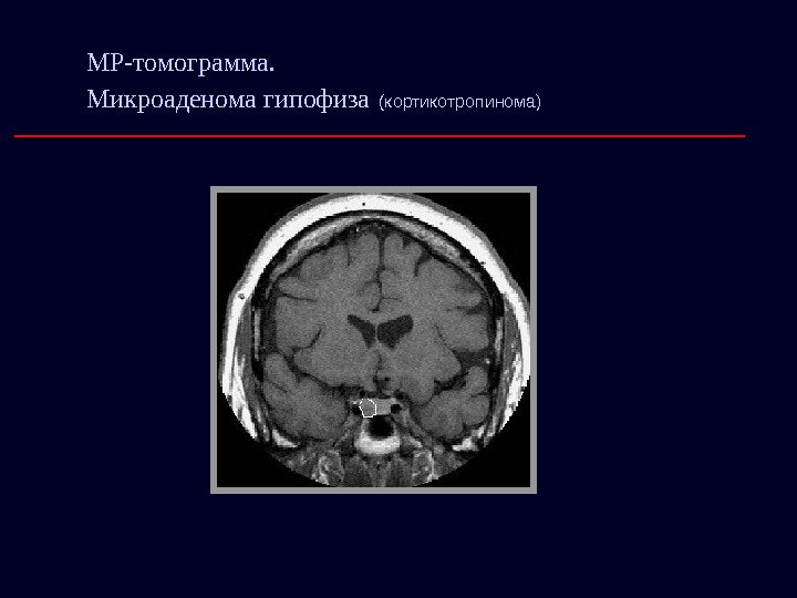 МР-томограмма.  Микроаденома гипофиза  (кортикотропинома) 