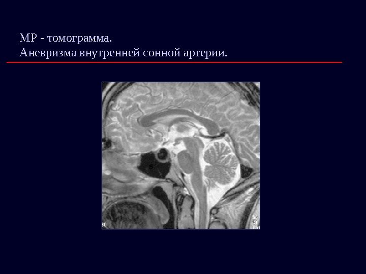 МР - томограмма.       Аневризма внутренней сонной артерии. 
