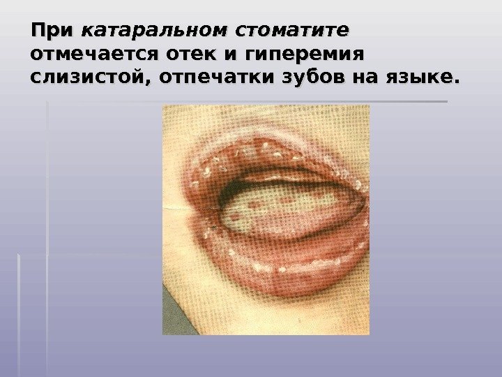 При катаральном стоматите  отмечается отек и гиперемия слизистой, отпечатки зубов на языке. 