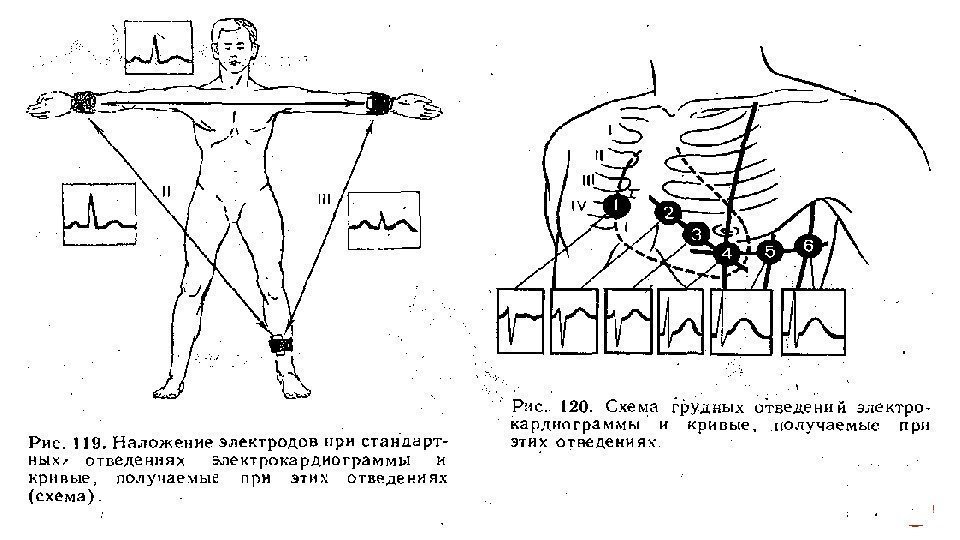 Экг наложение картинки