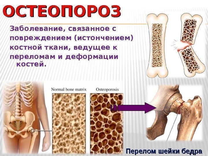 ОСТЕОПОРОЗ Заболевание, связанное с повреждением (истончением) костной ткани, ведущее к переломам и деформации костей.