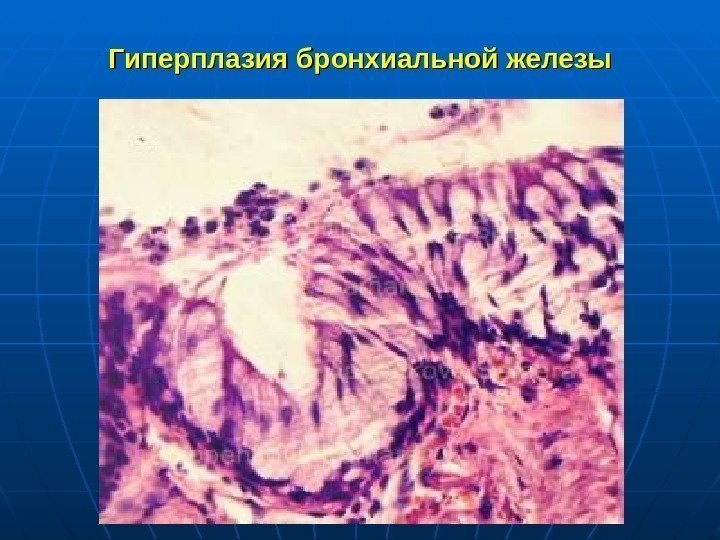 Гиперплазия бронхиальной железы 