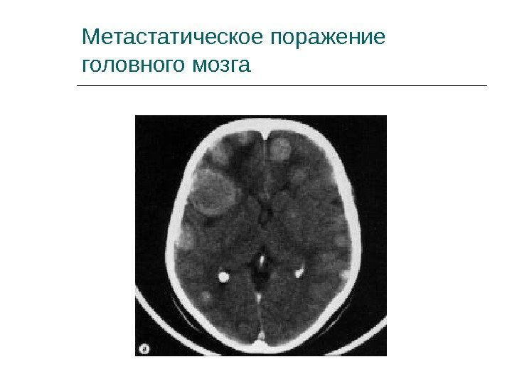Метастатическое поражение головного мозга 