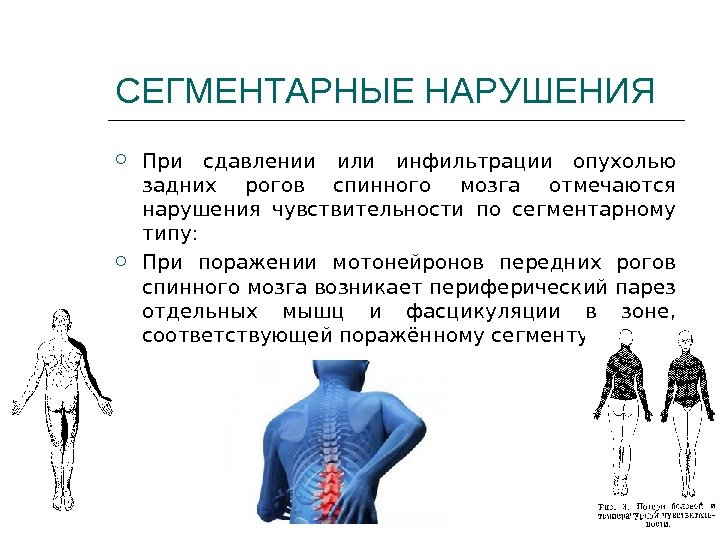 СЕГМЕНТАРНЫЕ НАРУШЕНИЯ При сдавлении или инфильтрации опухолью задних рогов спинного мозга отмечаются нарушения чувствительности