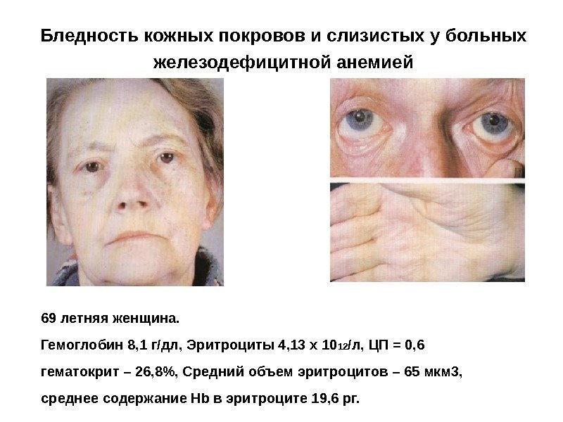 Бледность кожных покровов и слизистых у больных железодефицитной анемией 69 летняя женщина.  Гемоглобин