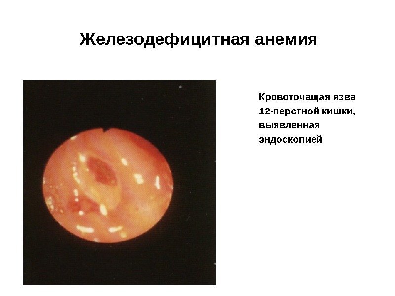 Железодефицитная анемия Кровоточащая язва 12 -перстной кишки,  выявленная эндоскопией 