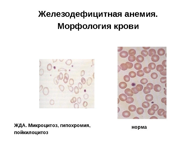 Железодефицитная анемия. Морфология крови ЖДА. Микроцитоз, гипохромия,  пойкилоцитоз норма 