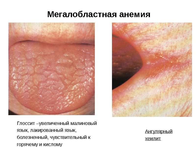 Мегалобластная анемия Глоссит –увеличенный малиновый язык, лакированный язык,  болезненный, чувствительный к горячему и