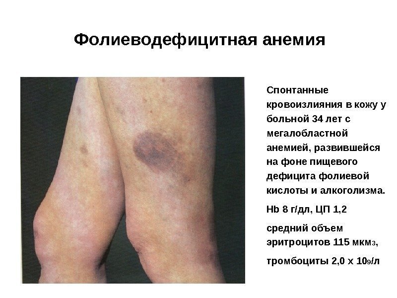 Фолиеводефицитная анемия Спонтанные кровоизлияния в кожу у больной 34 лет с мегалобластной анемией, развившейся