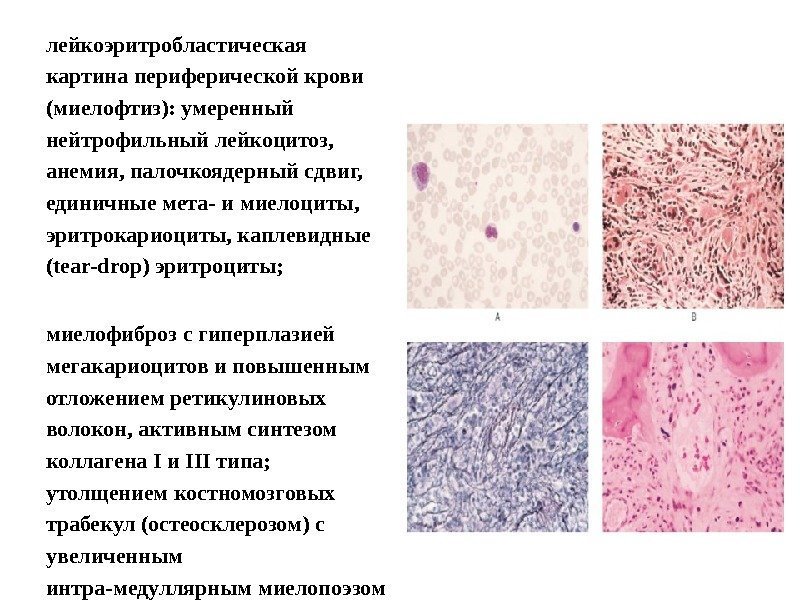 лейкоэритробластическая картина периферической крови (миелофтиз): умеренный нейтрофильный лейкоцитоз,  анемия, палочкоядерный сдвиг,  единичные