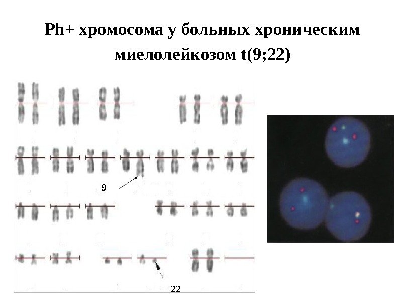 Ph+ хромосома у больных хроническим миелолейкозом t(9; 22) 229 