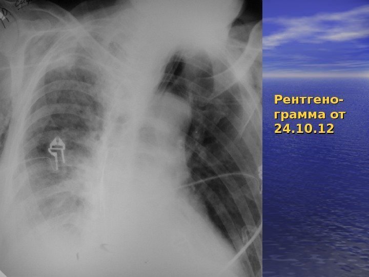 Рентгено- грамма от 24. 10. 12 
