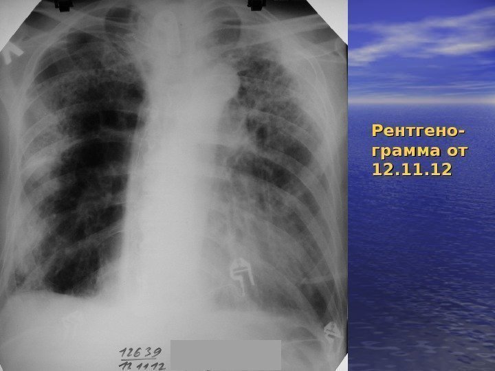 Рентгено- грамма от 12. 11. 12 