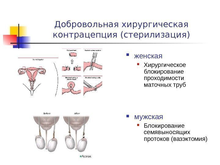 Добровольная хирургическая контрацепция (стерилизация) женская  Хирургическое блокирование проходимости маточных труб мужская Блокирование семявыносящих