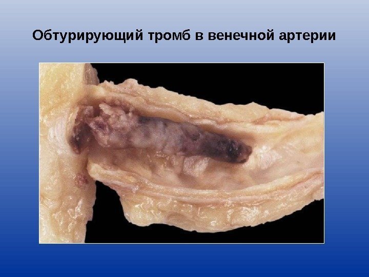 Обтурирующий тромб в венечной артерии 