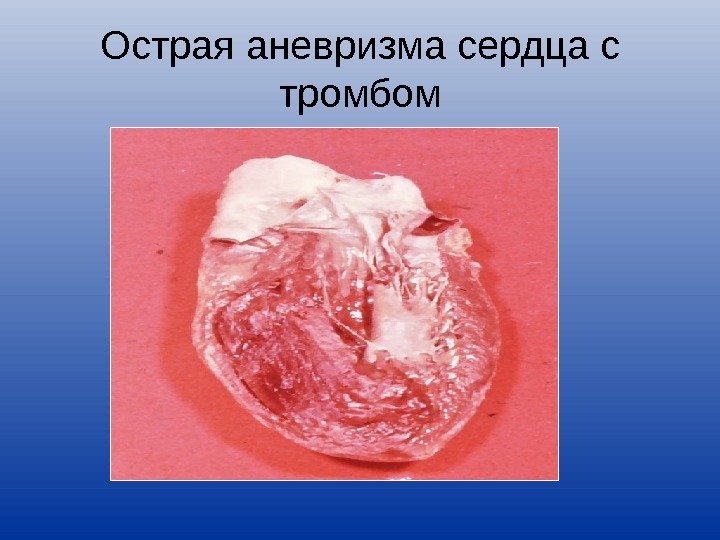 Острая аневризма сердца с тромбом 