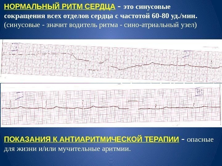 НОРМАЛЬНЫЙ РИТМ СЕРДЦА  - это синусовые сокращения всех отделов сердца с частотой 60