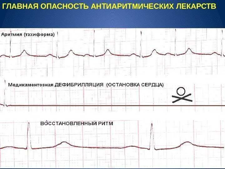 ГЛАВНАЯ ОПАСНОСТЬ АНТИАРИТМИЧЕСКИХ ЛЕКАРСТВ 