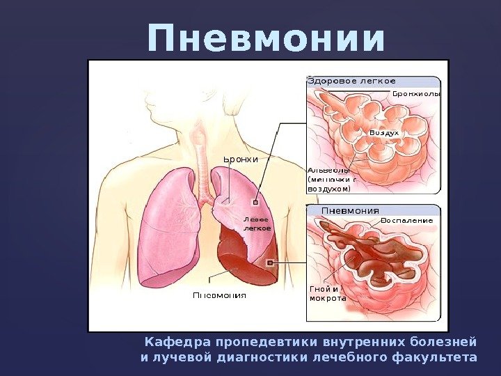 Пневмонии пропедевтика внутренних болезней презентация