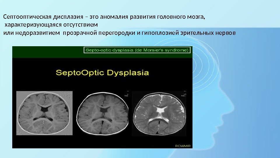 Септооптическая дисплазия – это аномалия развития головного мозга,  характеризующаяся отсутствием или недоразвитием прозрачной