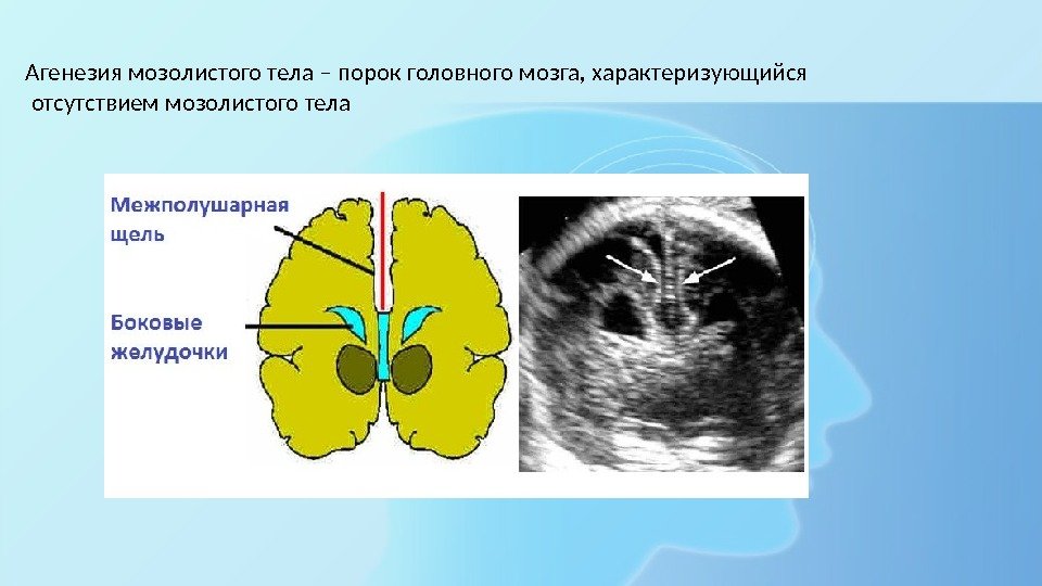 Агенезия мозолистого тела – порок головного мозга, характеризующийся  отсутствием мозолистого тела 