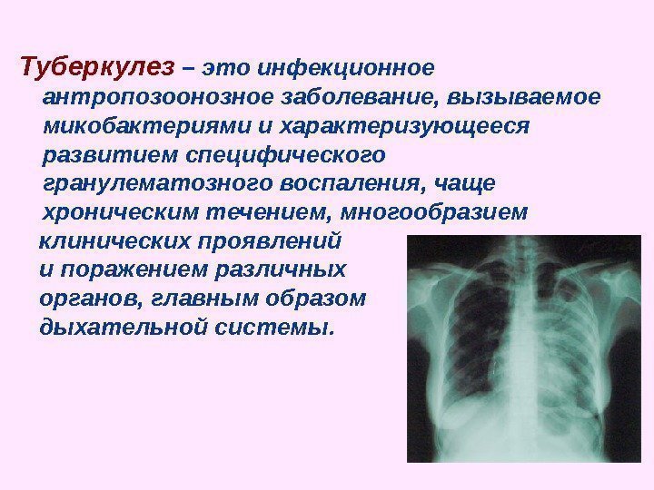   Туберкулез – это инфекционное антропозоонозное заболевание, вызываемое микобактериями и характеризующееся развитием специфического