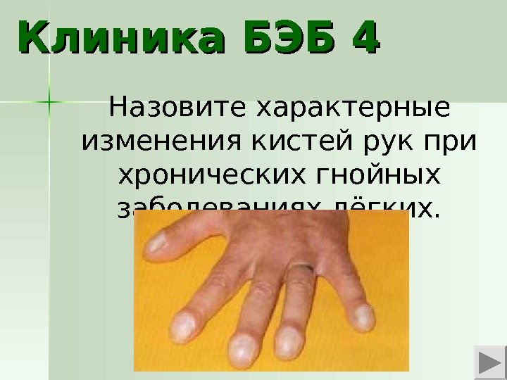 Клиника БЭБ 4 Назовите характерные изменения кистей рук при хронических гнойных заболеваниях лёгких. 