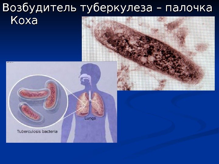 Возбудитель туберкулеза – палочка Коха 