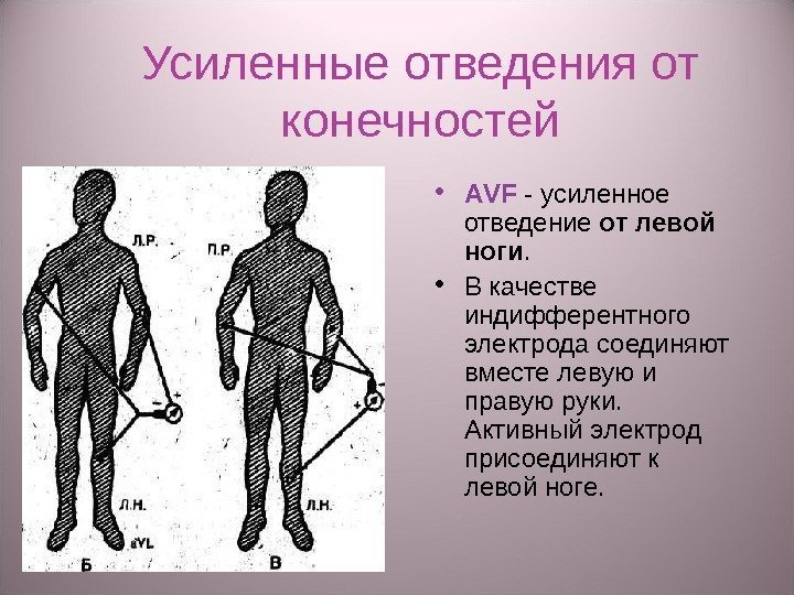 Усиленные отведения от конечностей • А VF  - усиленное отведение от левой ноги.