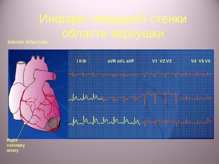 Инфаркт передней с тенки области верхушки Inferior infarction I II III a. VR a.