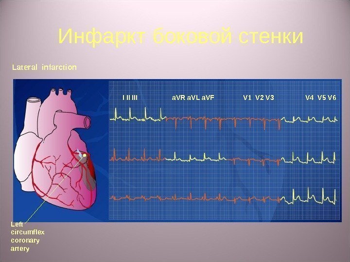 Инфаркт б оковой стенки Lateral infarction I II III a. VR a. VL a.