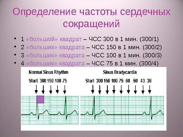 Определение частоты сердечных сокращений • 1  «большой» квадрат – ЧСС 300 в 1