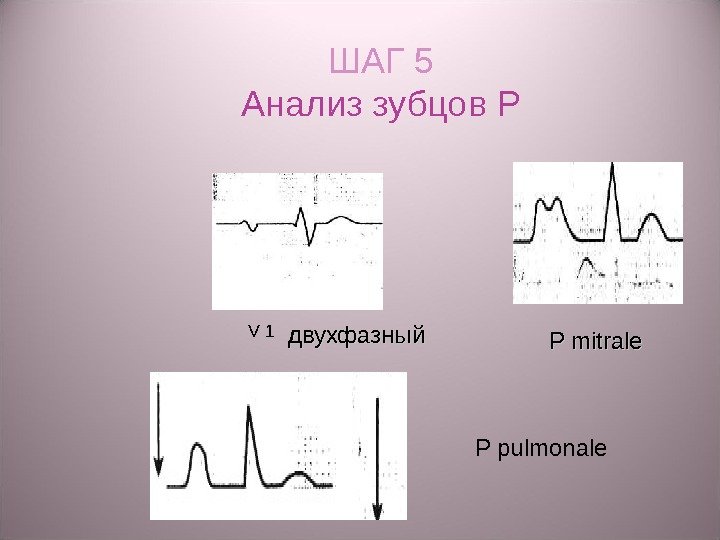 ШАГ 5 Анализ зубцов Р V 1 двухфазный P mitrale P pulmonale 