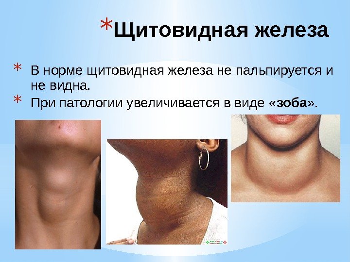 * В норме щитовидная железа не пальпируется и не видна. * При патологии увеличивается