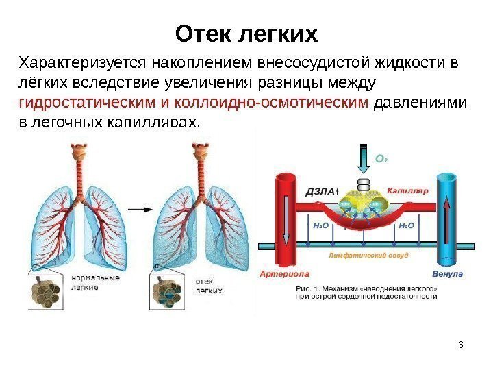 Отек легких 6 Характеризуется накоплением внесосудистой жидкости в лёгких вследствие увеличения разницы между гидростатическим
