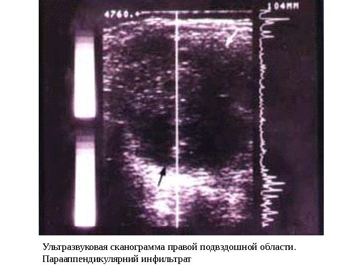 Ультразвуковая сканограмма правой подвздошной области.  Парааппендикулярний инфильтрат.  