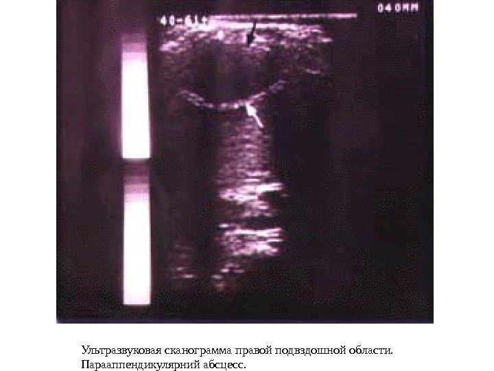 Ультразвуковая сканограмма правой подвздошной области.  Парааппендикулярний абсцесс.  