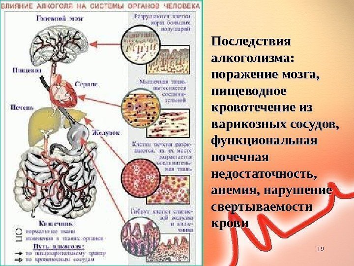       Последствия алкоголизма: поражение мозга,  пищеводное кровотечение из