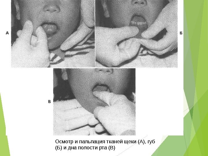 Осмотр и пальпация тканей щеки (А), губ (Б) и дна полости рта (В) 