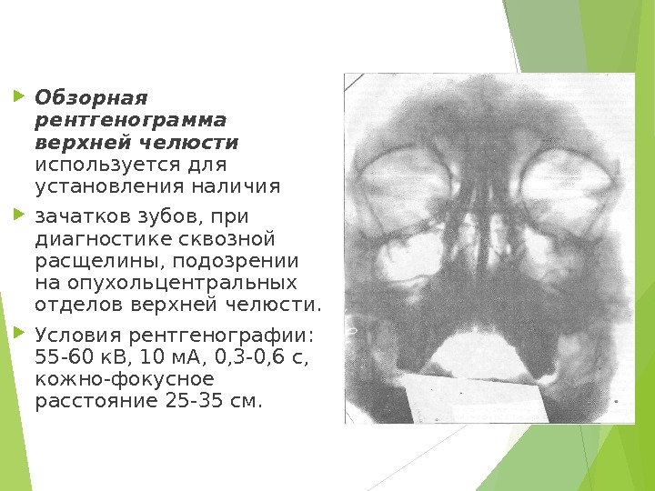  Обзорная рентгенограмма верхней челюсти используется для установления наличия зачатков зубов, при диагностике сквозной