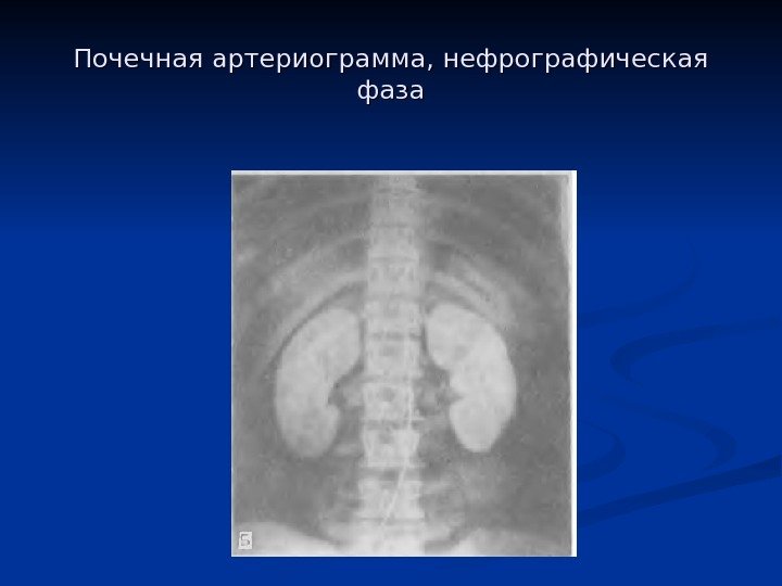 Почечная артериограмма, нефрографическая фаза 