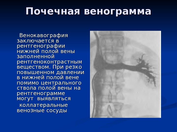 Почечная венограмма  Венокавография заключается в рентгенографии нижней полой вены заполненной рентгеноконтрастным веществом. При