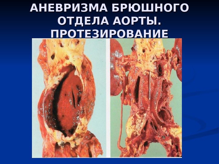 АНЕВРИЗМА БРЮШНОГО ОТДЕЛА АОРТЫ.  ПРОТЕЗИРОВАНИЕ 