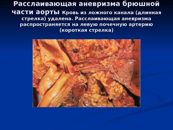 Расслаивающая аневризма брюшной части аорты Кровь из ложного канала (длинная стрелка) удалена. Расслаивающая аневризма