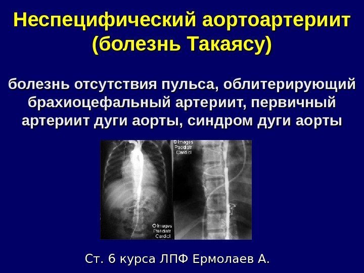 Неспецифический аортоартериит (болезнь Такаясу) болезнь отсутствия пульса, облитерирующий брахиоцефальный артериит, первичный артериит дуги аорты,