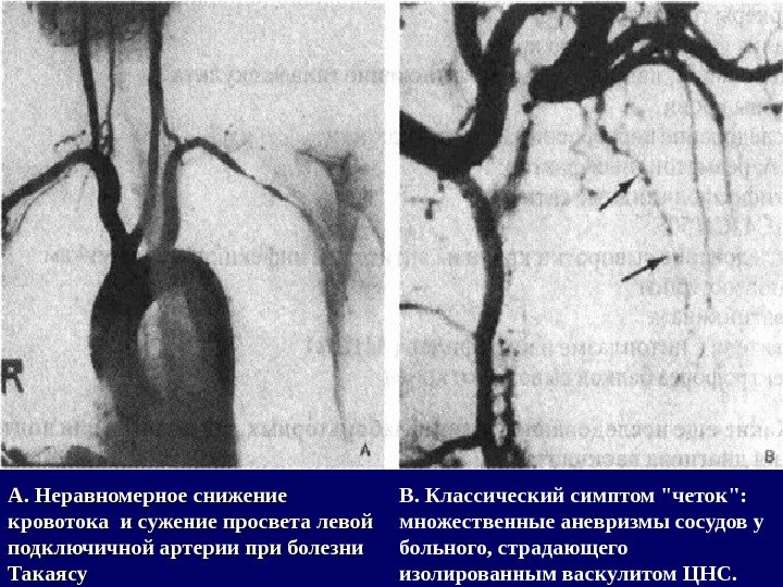 А. Неравномерное снижение кровотока и сужение просвета левой подключичной артерии при болезни Такаясу В.