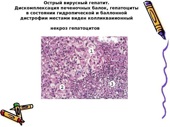   Острый вирусный гепатит. Дискомплексация печеночных балок, гепатоциты в состоянии гидропической и баллонной