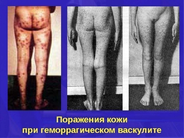 Поражения кожи при геморрагическом васкулите 